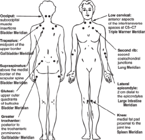 Fibromyalgia pressure points